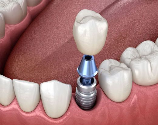 implant-supported crown