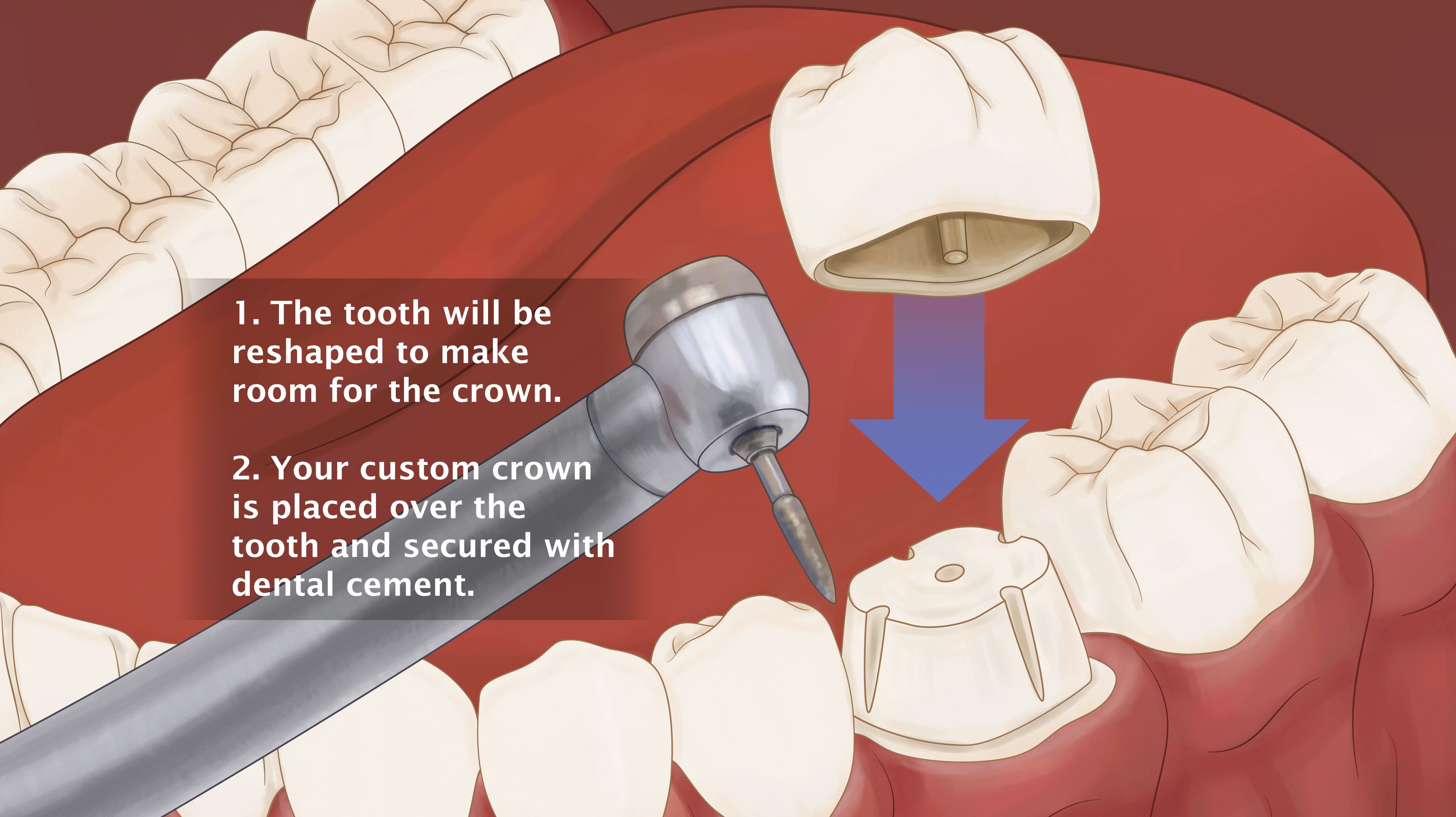 An illustration of a crown being placed on a tooth