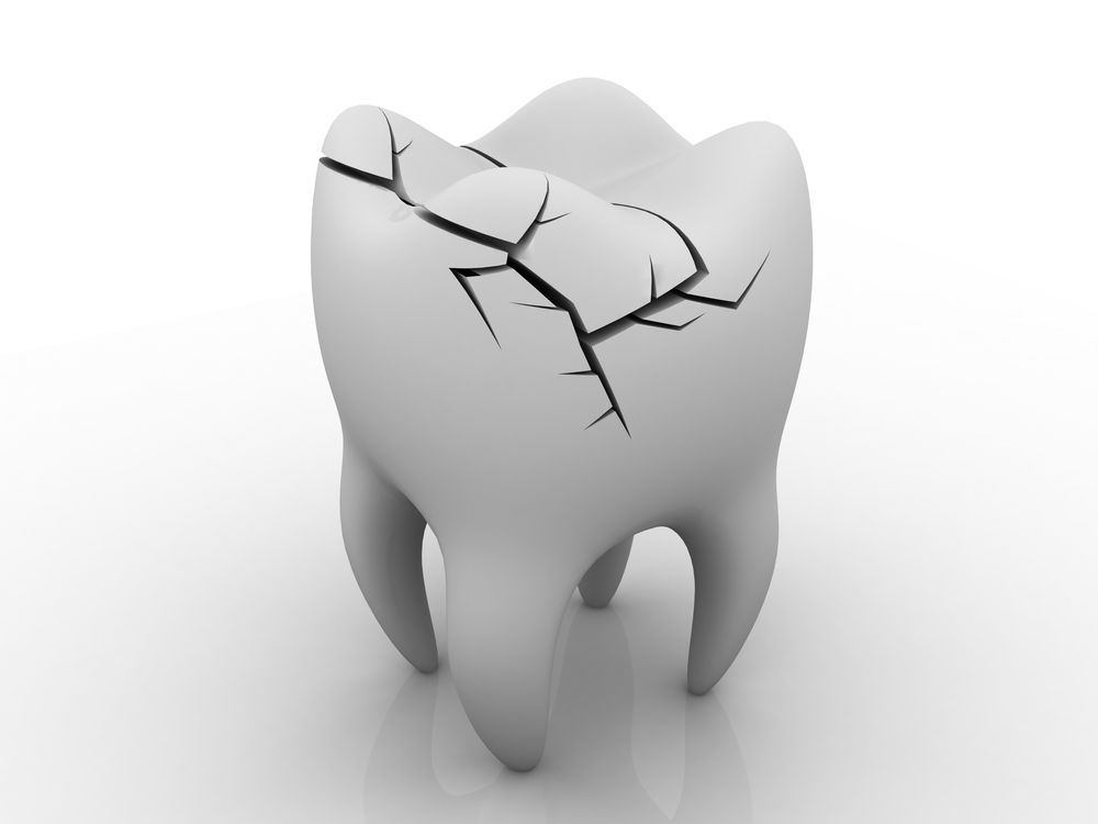 Illustration of cracked tooth