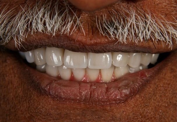 Dental Implants 2 after