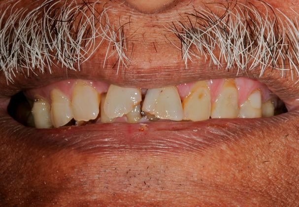 Dental Implants 2 before