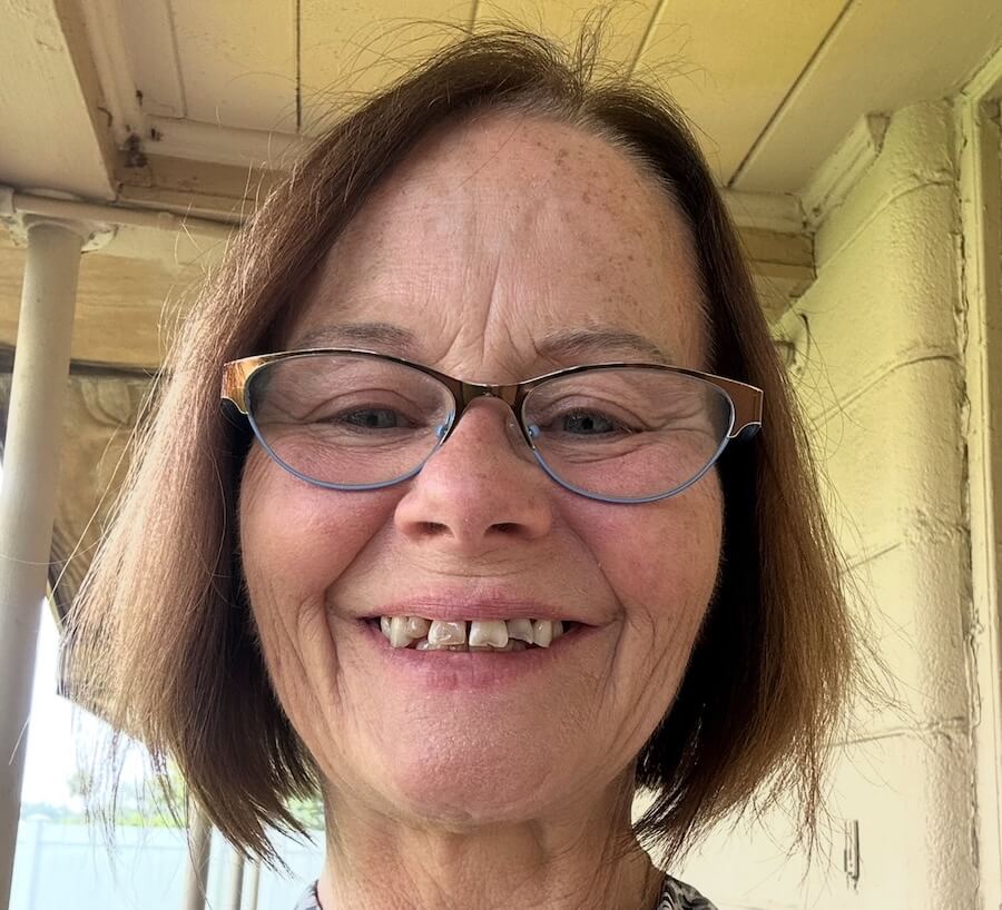 Partial Denture Before