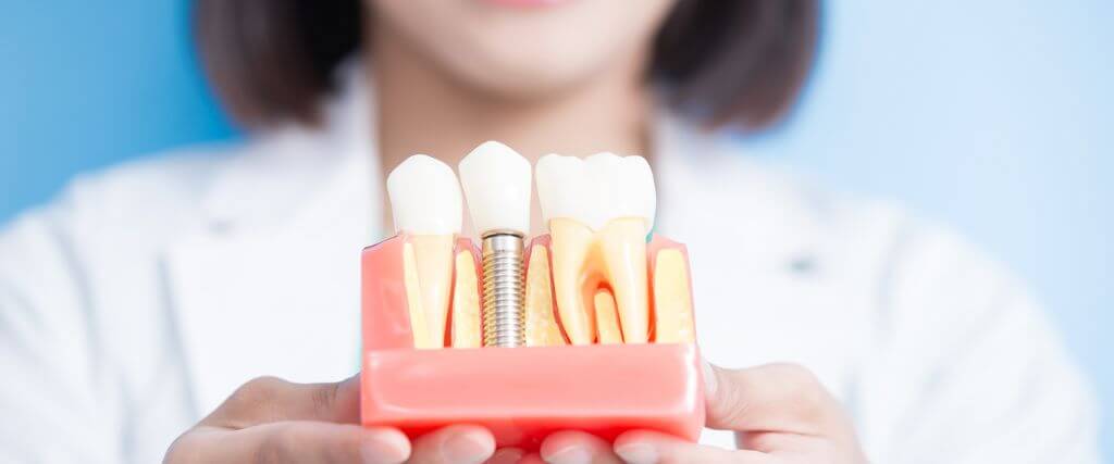 Addressing Failed Implants: Strategies for Successful Implant Restoration