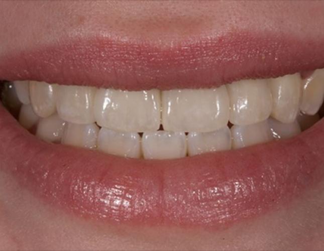 Dental Implants 1 after