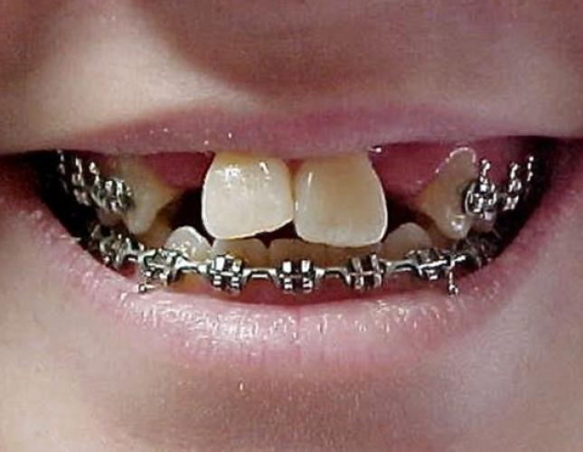Dental Implants 1 before