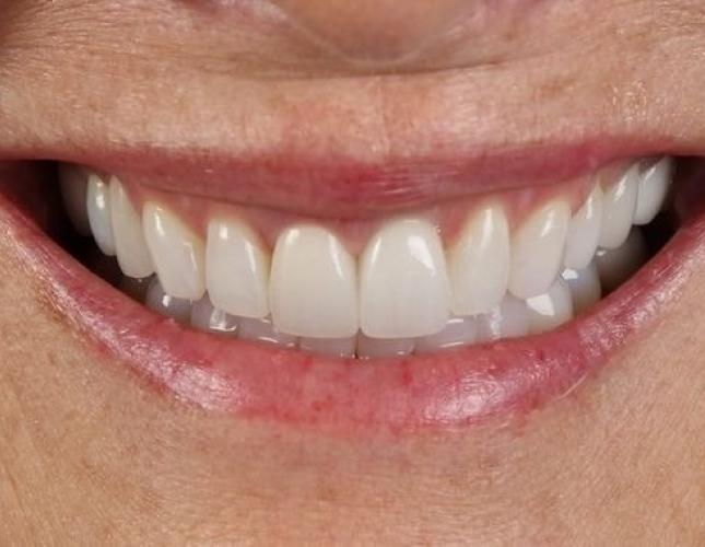 Dental Implants 7 after