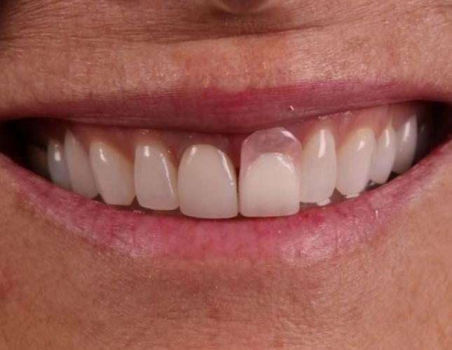 Dental Implants 7 before