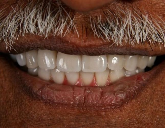Dental Implants 2 after
