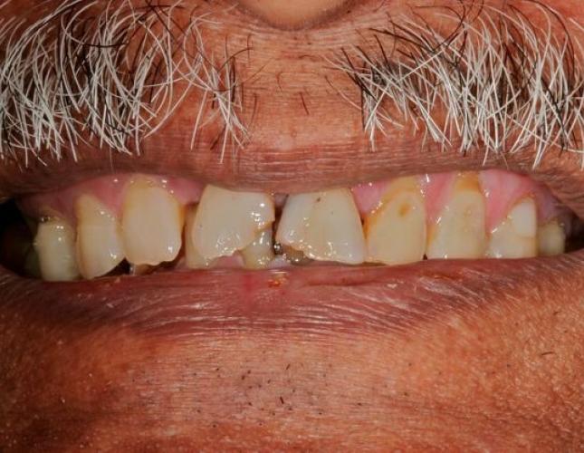 Dental Implants 2 before