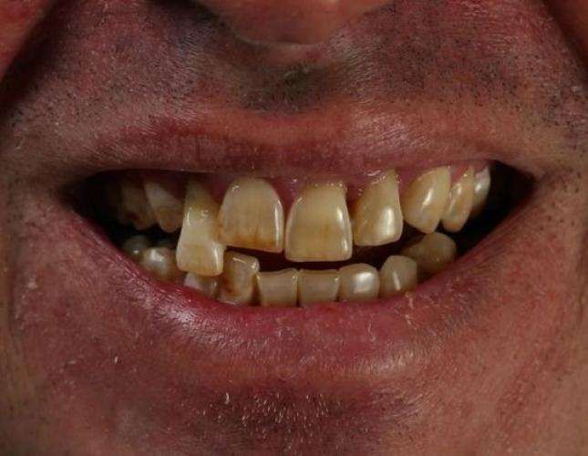 Dental Implants 2 before