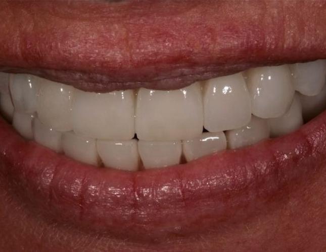 Dental Implants 3 after