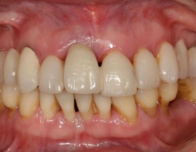 Dental Implants 3 before