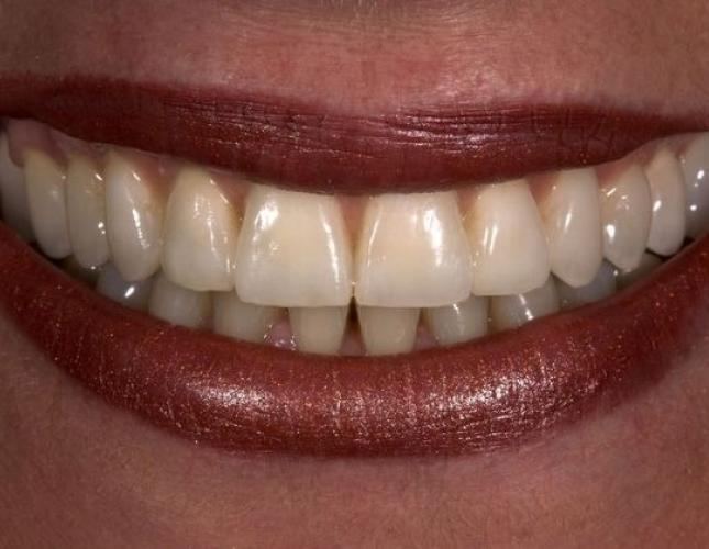 Dental Implants & Crowns 3 after