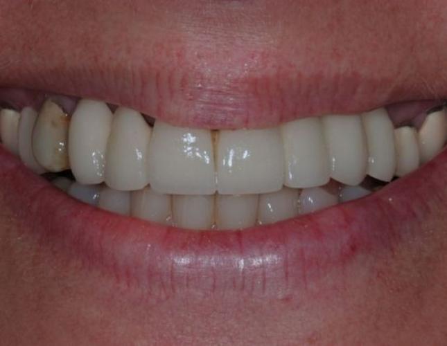 Dental Implants & Crowns 3 before