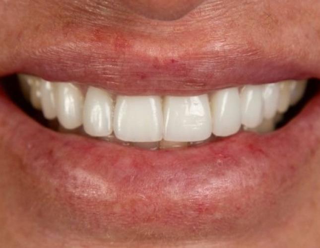 Dental Implants 4 after