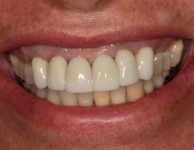 Dental Implants 4 before
