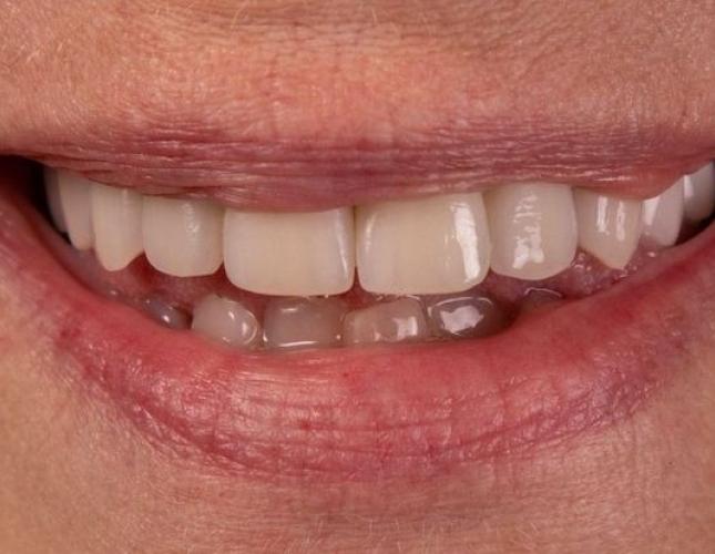 Dental Implants 5 after