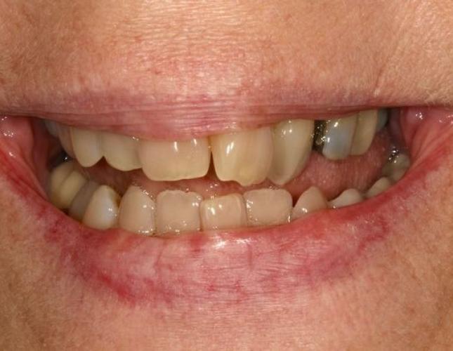 Dental Implants 5 before
