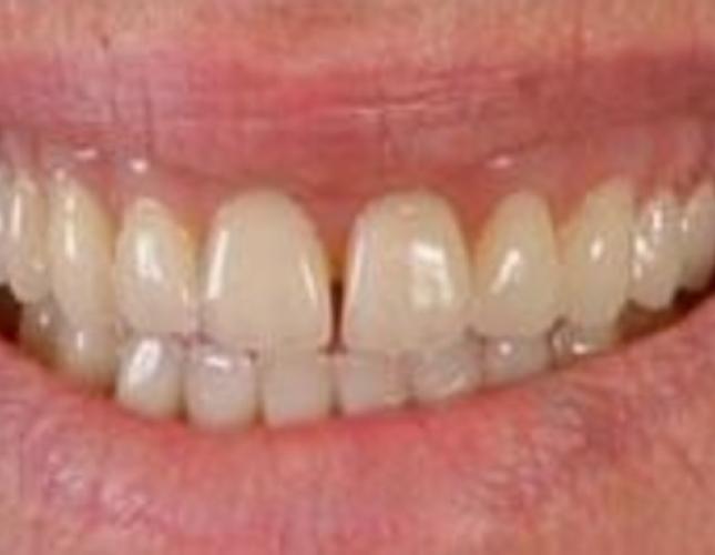 Dentures 1 after
