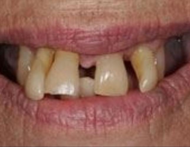 Dentures 1 before
