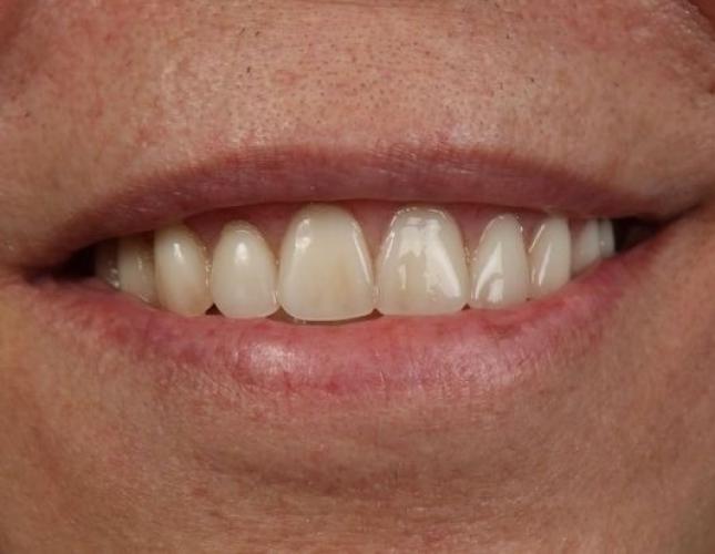 Dentures 3 after