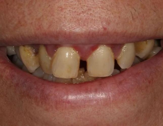 Dentures 3 before