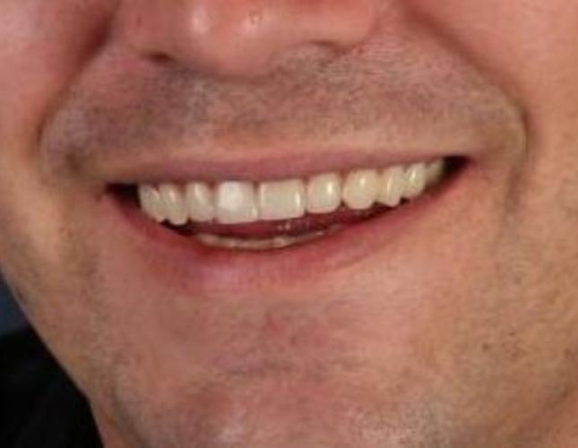 Dentures 6 after