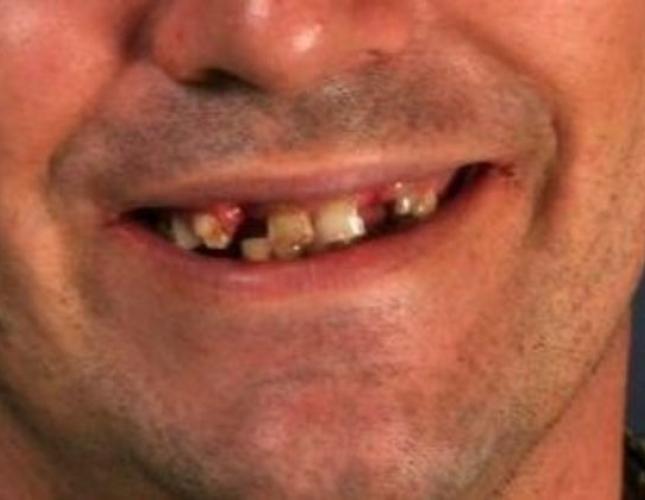 Dentures 6