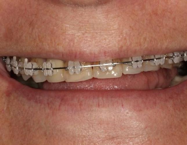 Porcelain Crowns 1 before