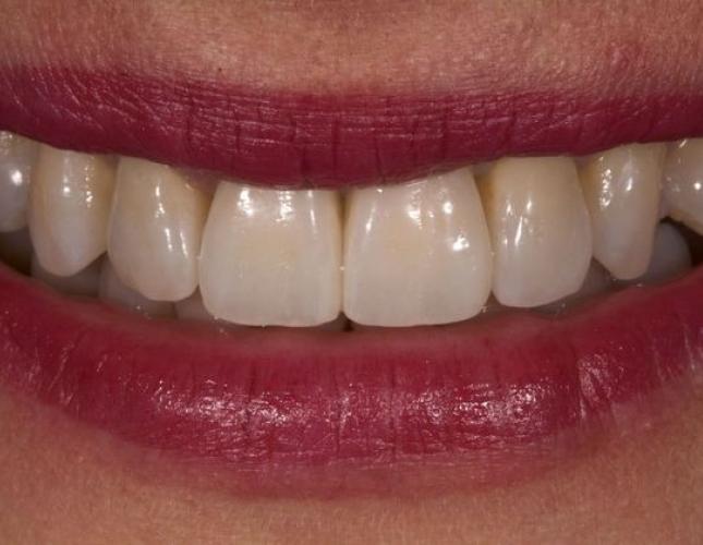 Porcelain Crowns 3 after