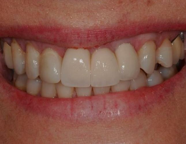 Porcelain Crowns 3 before