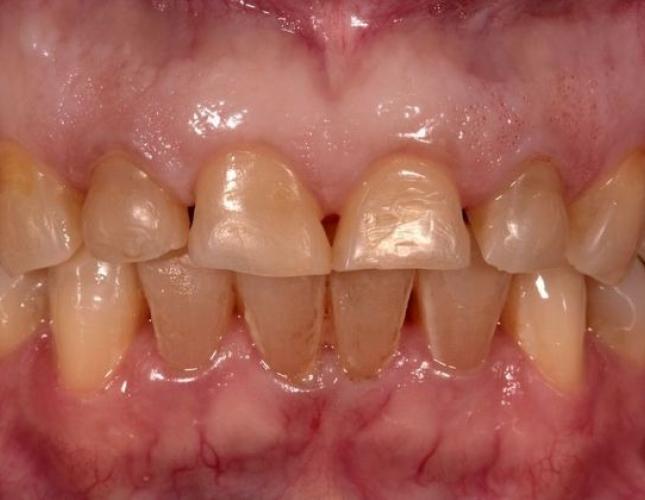 Porcelain Crowns 4 before