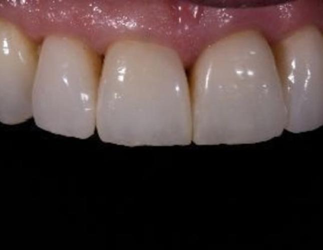 Porcelain Crowns 5 after