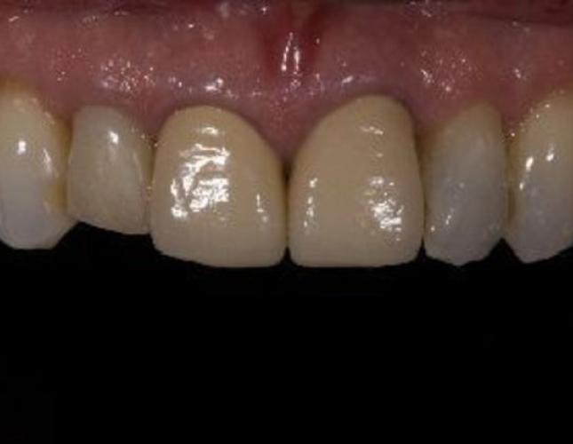 Porcelain Crowns 5 before