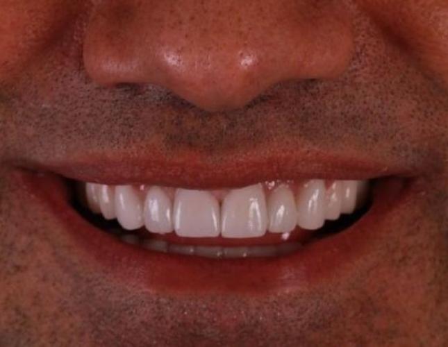 Porcelain Crowns 6 after