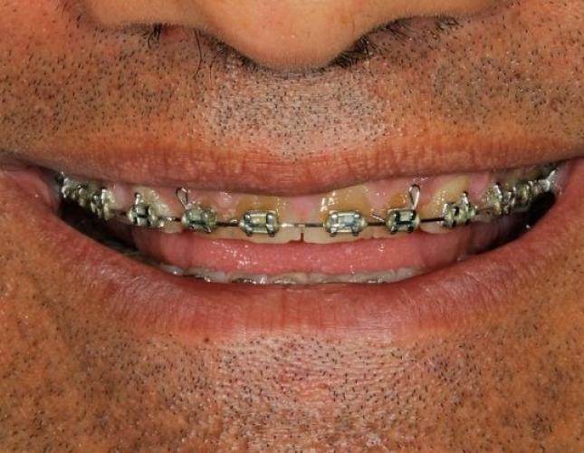 Porcelain Crowns 6 before