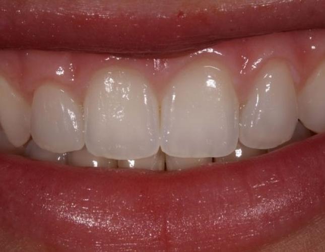 Veneers 1 after