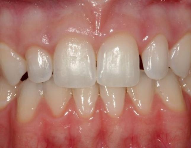 Veneers 1 before
