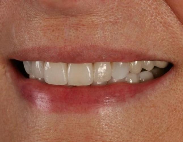 Veneers 2 after