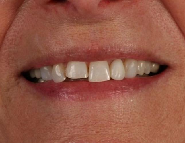 Veneers 2 before