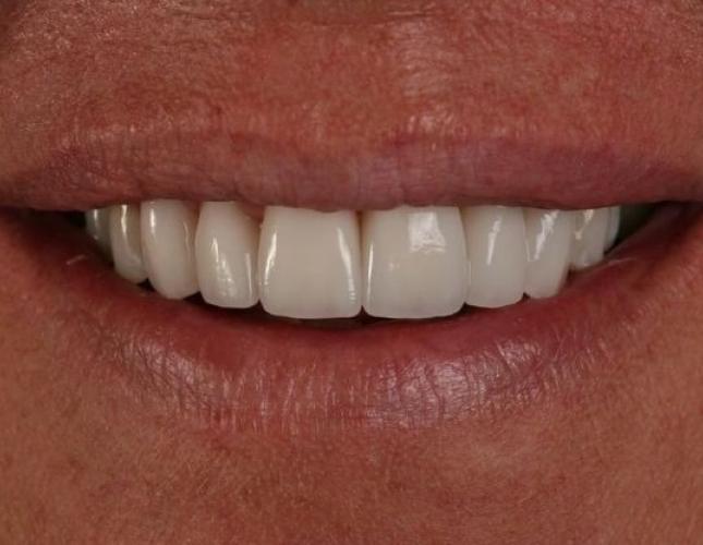 Veneers 3 after