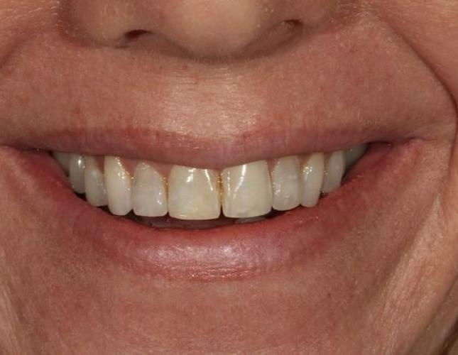 Veneers 3 before