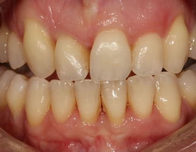 Veneers 4 before