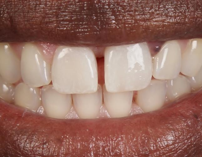 Crowns after