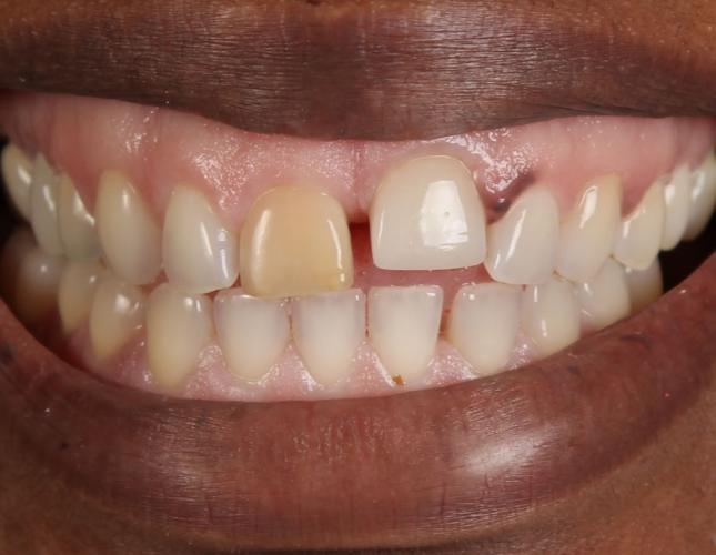 Crowns before