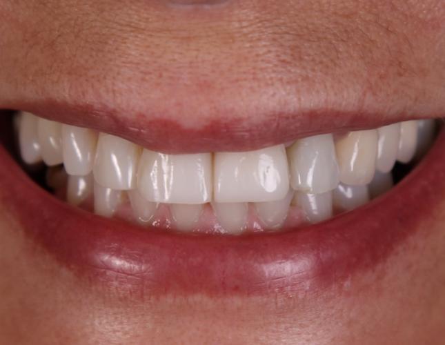 Veneers 5 after