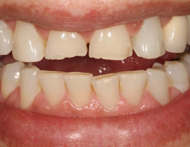 Veneers 5 before