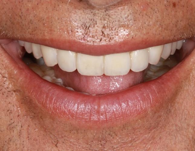 Dental Implants 2 After