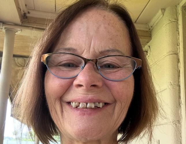 Partial Denture Before