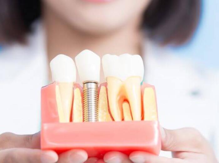 Addressing Failed Implants: Strategies for Successful Implant Restoration